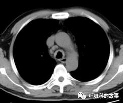 【南京新增无症状感染者抗体阳性,南京无症状感染者有哪些症状】