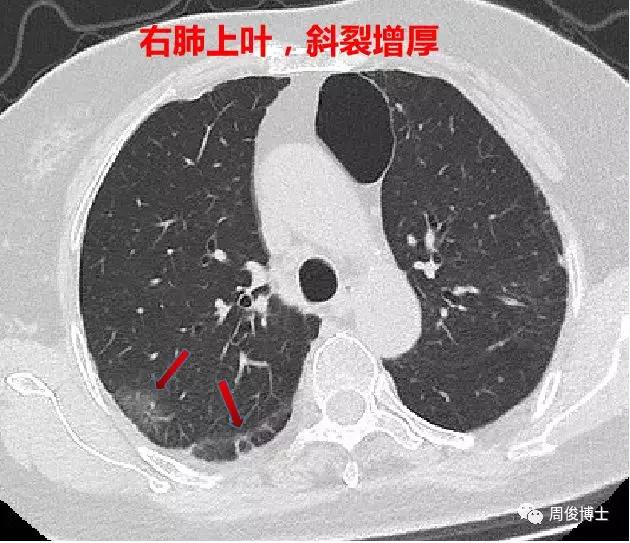 广东增13例感染者/广东确认新增13例新型冠状病毒感染肺炎