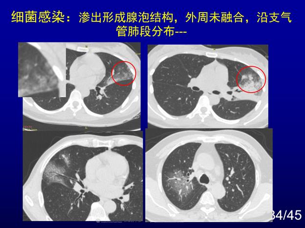 浙江省新型肺炎(浙江省新冠肺炎)